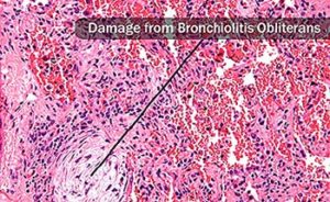 Bronchiolitis Treatment in Ayurveda